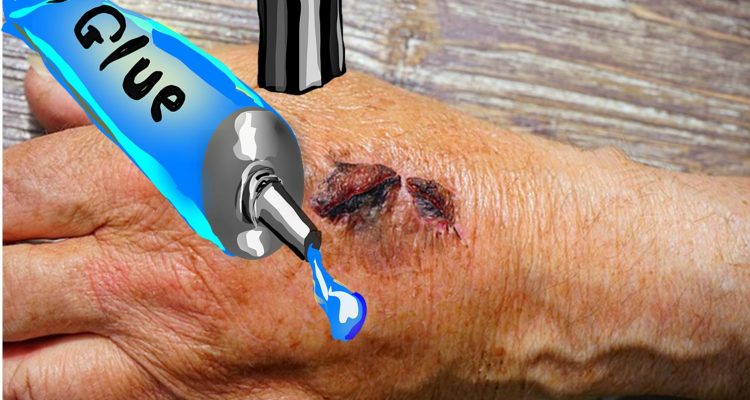 MeTro - A Fast-Sealing Surgical Glue for closing up Surgical wounds